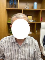 -大麦微针植发全国连锁