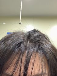 -碧莲盛·不剃发植发