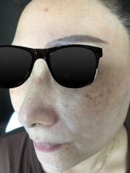 -爱莎扁平疣·汗管瘤·斑痣中心