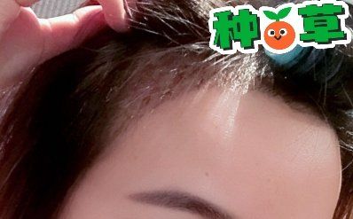 -大麦微针植发丨全国连锁