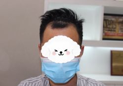 体验前-大麦微针植发全国连锁