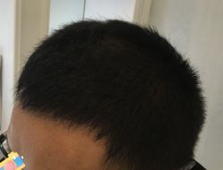 -大麦微针植发丨全国连锁