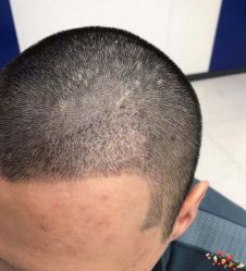 -大麦微针植发丨全国连锁