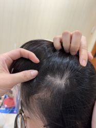 -碧莲盛·不剃发植发