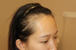 -大麦微针植发丨全国连锁