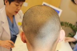 -大麦微针植发丨全国连锁