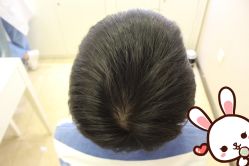 点击看大图 -大麦微针植发丨全国连锁