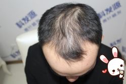 -大麦微针植发丨全国连锁