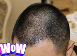 -大麦微针植发丨全国连锁