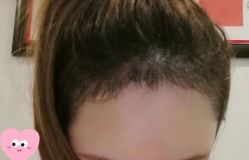 -大麦微针植发丨全国连锁