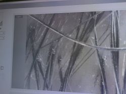 -碧莲盛·不剃发植发