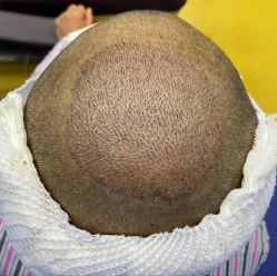 -雍禾植发全国连锁