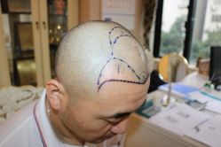 -大麦微针植发丨全国连锁