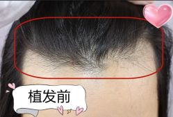 -大麦微针植发丨全国连锁