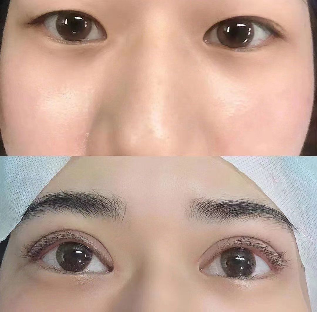 割双眼皮前后对比