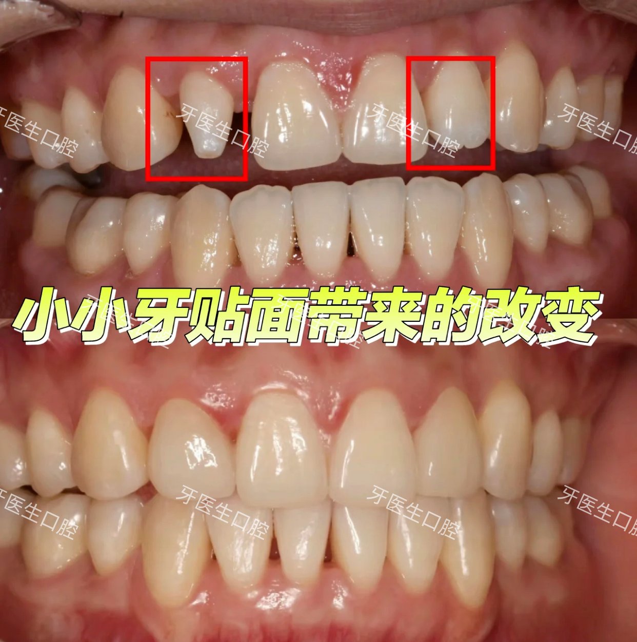 通常会一起做16颗牙贴面,但是也有特殊情况,比如门牙黑,单颗牙齿偏小