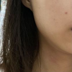 体验后-深圳美莱医疗美容医院