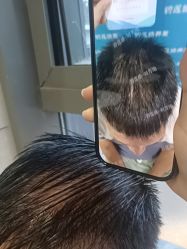 -碧莲盛·不剃发植发