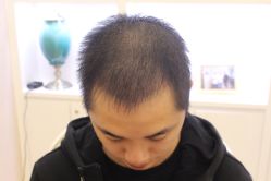 -大麦微针植发丨全国连锁