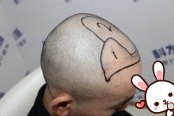 点击看大图 -大麦微针植发丨全国连锁