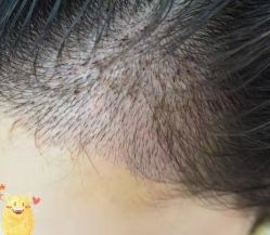 -大麦微针植发丨全国连锁