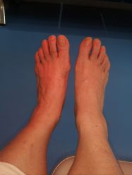 -足太医扦脚·灰指甲·嵌甲