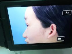 体验后-西安壹加壹医疗美容·西北抗衰旗舰店