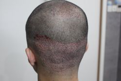 点击看大图 -大麦微针植发丨全国连锁