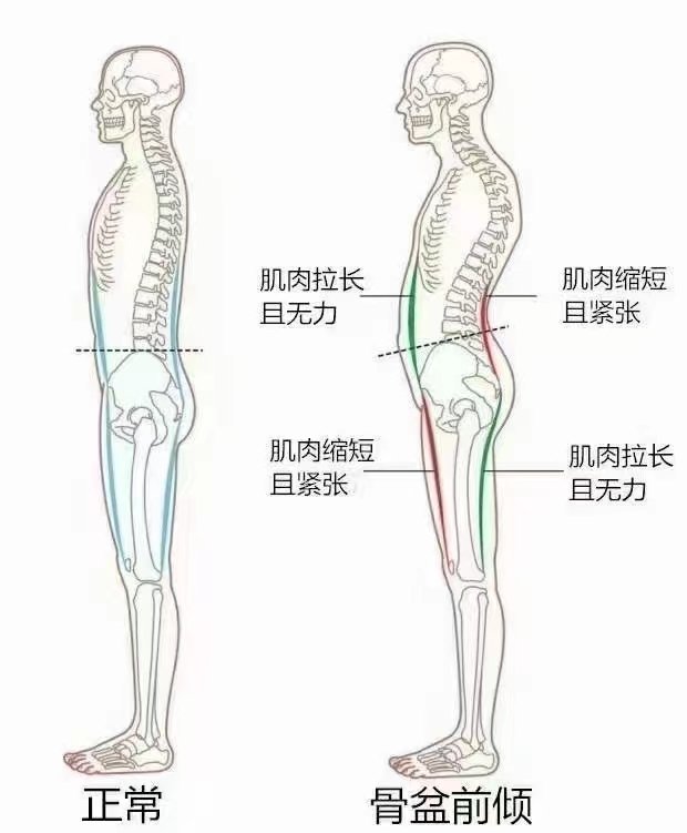 下交叉综合症矫正图解图片