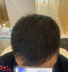 -大麦微针植发丨全国连锁