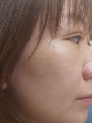 体验后-北京美痣堂古方祛痣斑疣瘊
