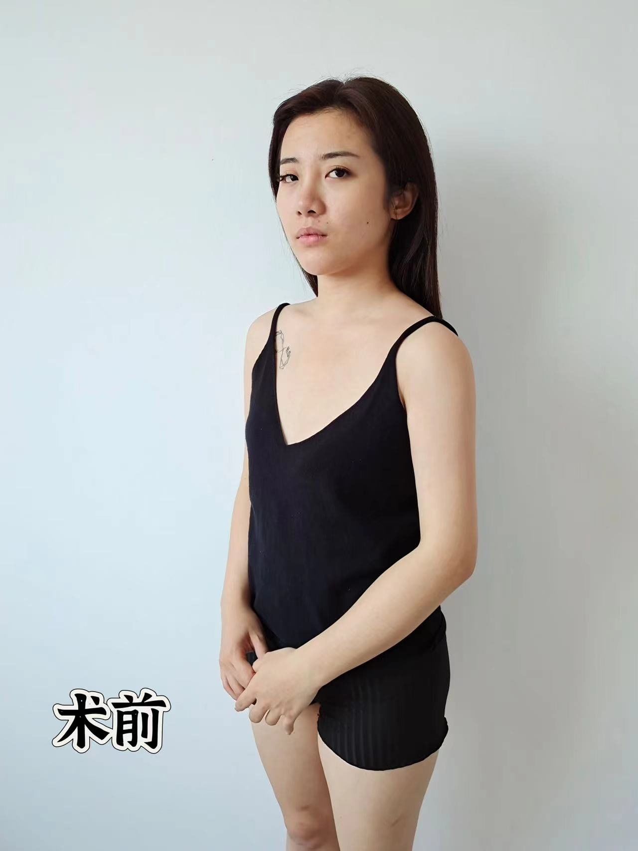 do胸术后的真实感受分享