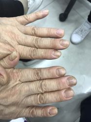 -德哥灰指甲脚气甲沟炎跖疣护理