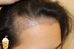 -大麦微针植发丨全国连锁