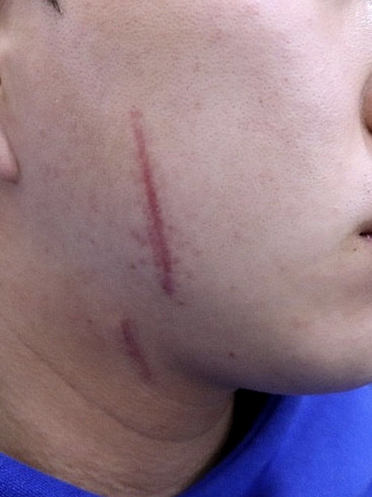 脸上缝针留了很大一道红色疤痕,等了个把月