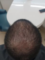 点击看大图 -大麦微针植发丨全国连锁