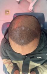 体验后-大麦微针植发全国连锁