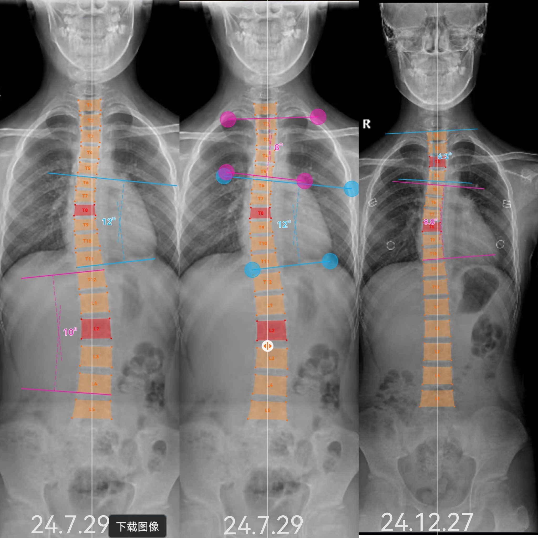 成长轨迹:骨骼x光对比