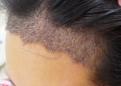 -大麦微针植发全国连锁