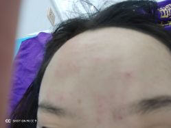 -蕾特恩专业祛痘国际连锁
