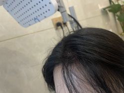 -碧莲盛·不剃发植发