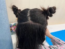 -碧莲盛·不剃发植发