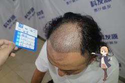 -大麦微针植发丨全国连锁