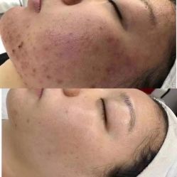 -美肤盾祛痘·问题肌头疗管理中心