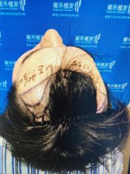 体验前-雍禾植发全国连锁