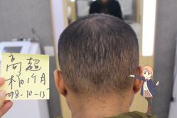 -大麦微针植发丨全国连锁