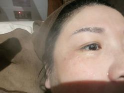 点击看大图 提斑后冷喷时自拍-北京英煌医疗美容