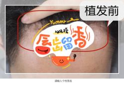 -大麦微针植发全国连锁