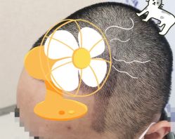 -大麦微针植发全国连锁