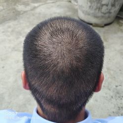 -碧莲盛·不剃发植发